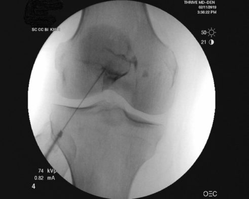 x-ray arthritic knee stem cell injection