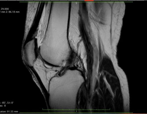 Stem cell patient knee sagittal MRI