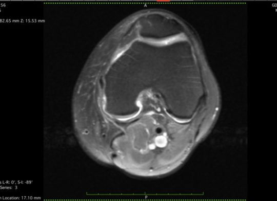 stem cell patient knee axial MRI